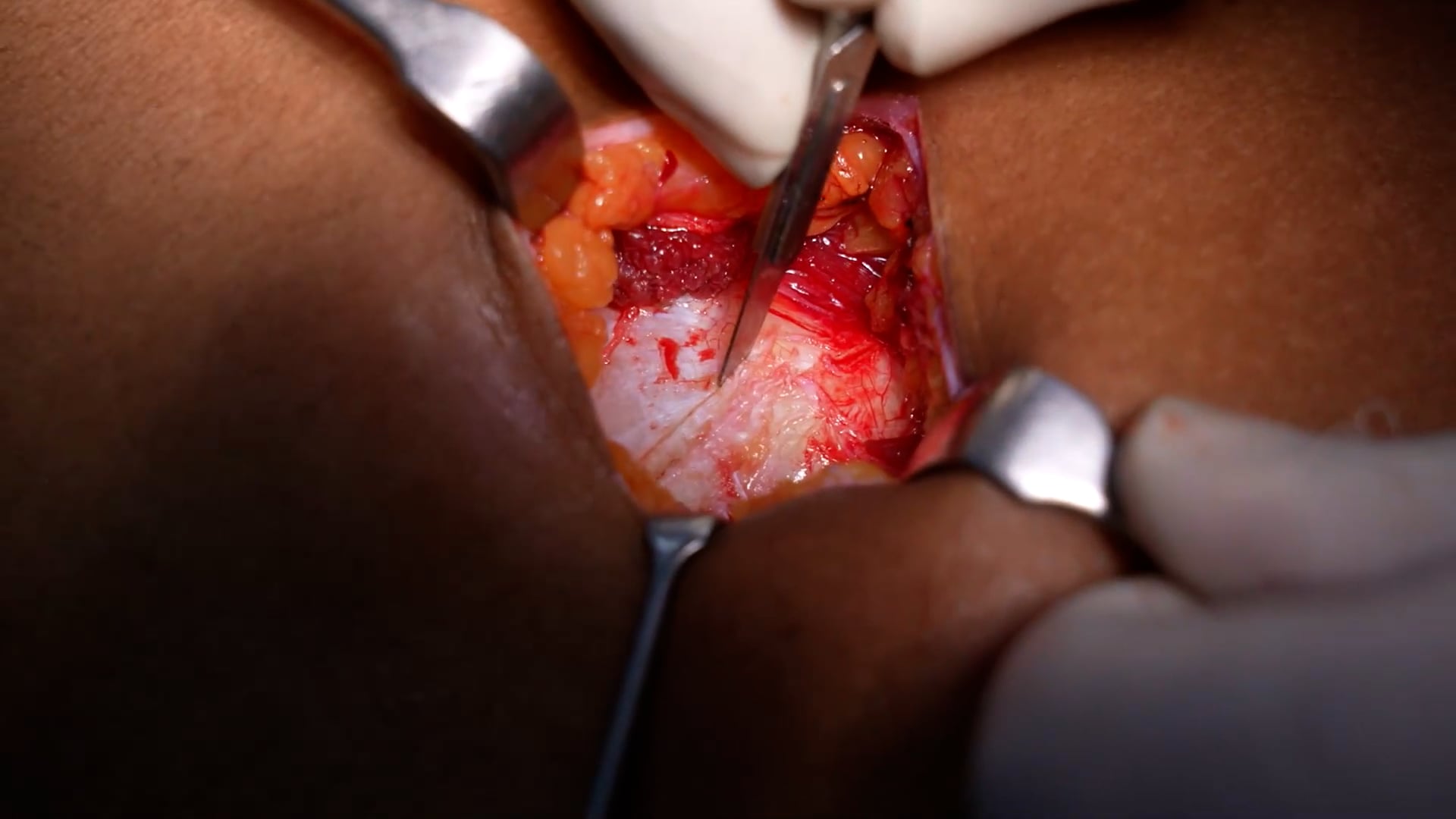 Rib Graft Harvesting